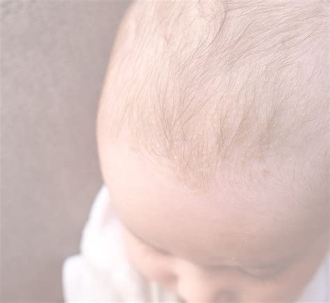 Cradle Cap On Your Babys Face Causes And Treatment