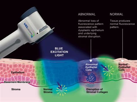 Early Detection With Velscope Advanced Dentistry Of Westchester