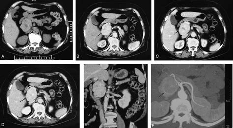 Abdominal Computed Tomography Ct Scan Findings Black Arrow A