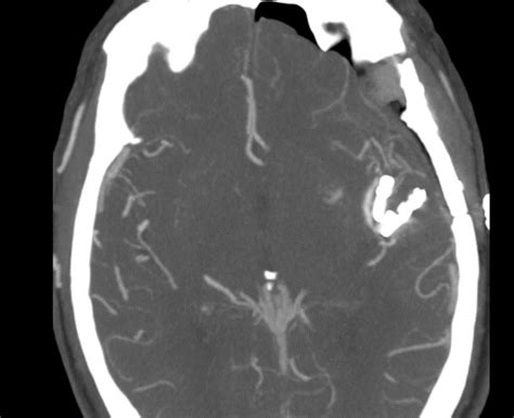 Clipping Mca Aneurysm Via Left Pterional Approach