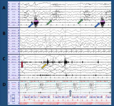 The Video Polysomnography A Polysomnograpic 18 S Epoch With 2 Download Scientific Diagram