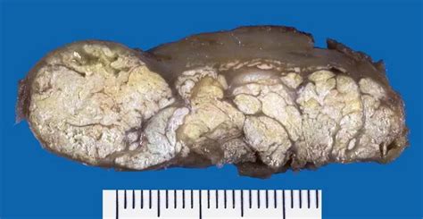 Chronic Tophaceous Gout : Gross Pathology