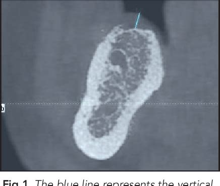 Figure From Influence Of Implant Placement Depth And Soft Tissue