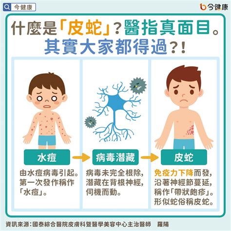 皮蛇長一圈會有生命危險？醫：帶狀皰疹長在眼睛、肛門要注意！ 今健康