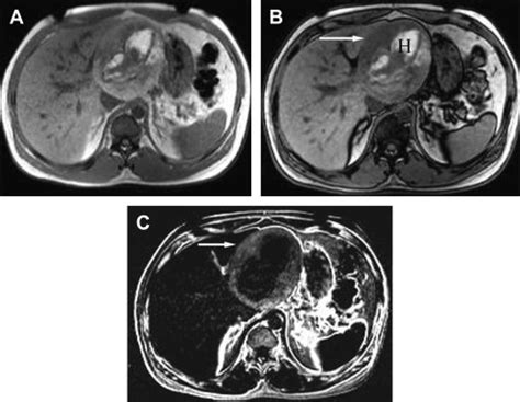 Mr Characterization Of Focal Liver Lesions Magnetic Resonance Imaging