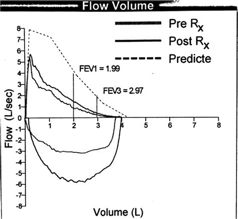 Flow Volume Loop Of Pulmonary Function Test Download Scientific Diagram