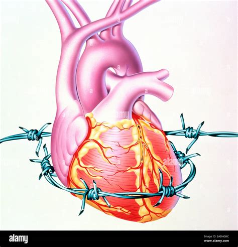 Angina Pectoris Illustration Of A Heart With Barbed Wire Coiled Around