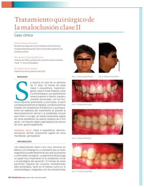 Tratamiento Quir Rgico De La Maloclusi N Clase Ii