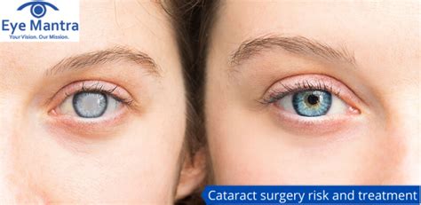 Cataract Surgery Risk And Treatment Cataract Complications