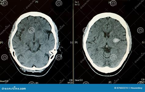 Brain Bleed On Ct Scan