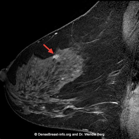 Breast MRI | DenseBreast-info, Inc.