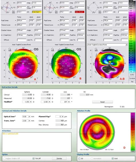 A Preoperative Anterior Topography And Keratometric Parameters