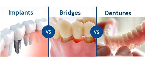 Analyzing Dental Bridge Treatment in Hong Kong