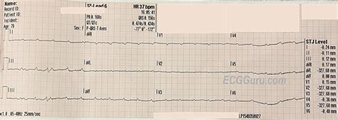 Bifascicular Block Ecg Guru Instructor Resources