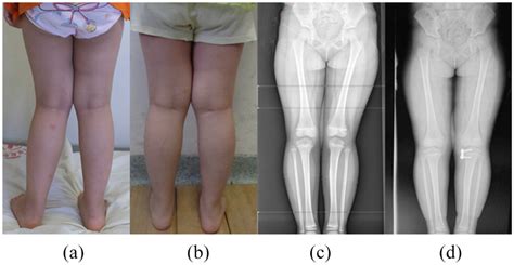 Case 1 A 4 9 Year Old 18 6 Kg Girl With Idiopathic Genu Valgum After Download Scientific