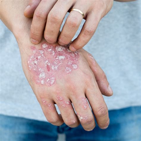 How Can Salt Therapy Help Psoriasis — Halo Salt Centre