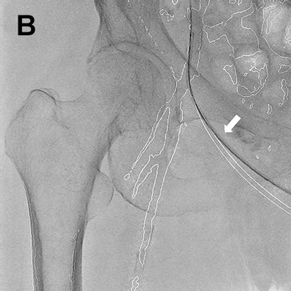 下肢血管腔内治疗方面最大限度地运用Trinias的应用程序 用户体验 Minimally Invasive Experience 岛津医疗