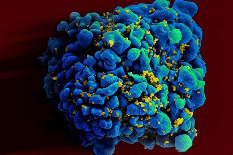 Third Person Cured Of HIV After Stem Cell Transplant Study ABS CBN News