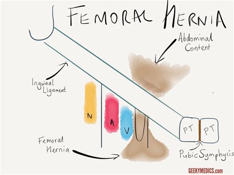 Hernias Inguinal Femoral Umbilical Geeky Medics