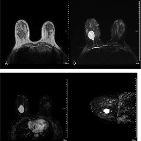 Axial T2 Weighted A And Axial Post Contrast Image B Demonstrate A