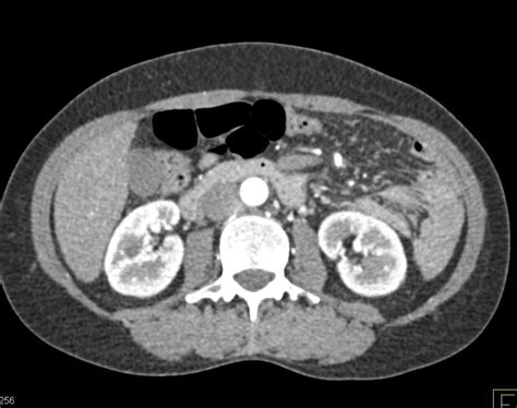 Internal Hernia With Midgut Volvulus With Small Bowel Obstruction And