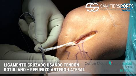 Reconstrucci N Del Ligamento Cruzado Con Tendon Rotuliano Refuerzo