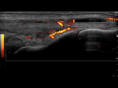 Extensor Compartment Tenosynovitis Ultrasound Cases