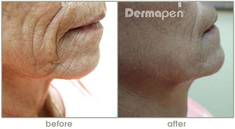 dermapen_before-and-after-1 - Linda Muniz LME