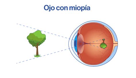 Cuáles son las diferencias entre miopía y astigmatismo