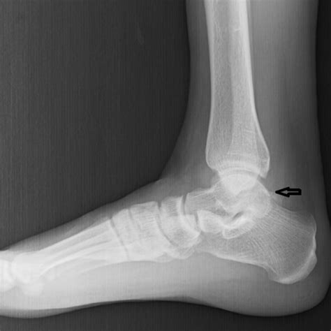 OS Trigonum Fracture