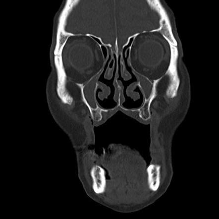 Opacified Hypoplastic Maxillary Sinus Image Radiopaedia Org