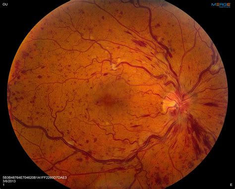 Ischemic Central Retinal Vein Occlusion