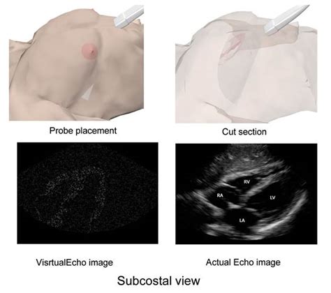 Echocardiography Principles Virtualecho Echocardiography Simulator