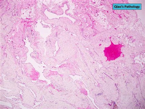 Pathology Outlines Venous Hemangioma