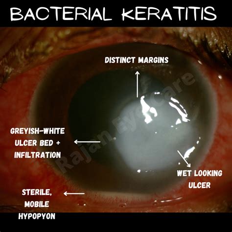 Signs Of Bacterial Keratitis