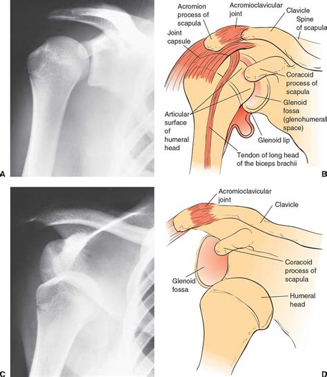 Shoulder Dislocation and Reduction | Anesthesia Key