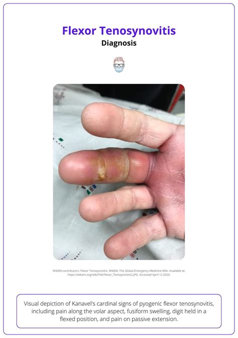 Pyogenic Flexor Tenosynovitis Anatomy Clinical View And Treatment