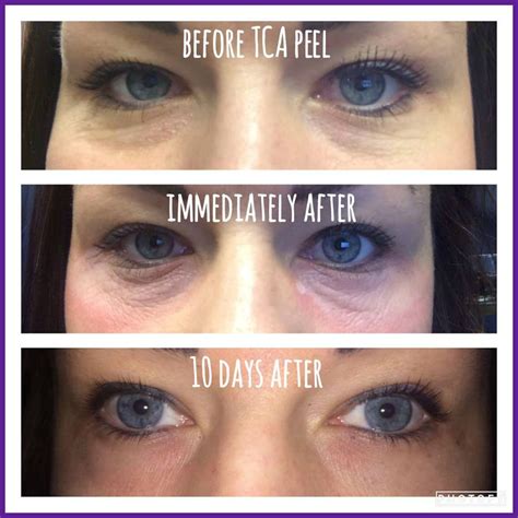 Under Eye Tca Peel Before And After Mujicafaruolo