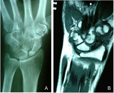 Dorsal Capsular Based Vascularized Distal Radius Graft For Proximal