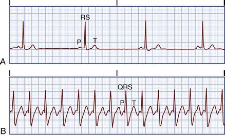 Types Of Dysrhythmias Flashcards Quizlet