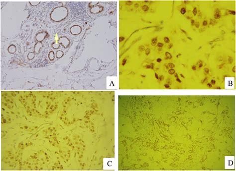 Immunohistochemical Expression Of Er β A Normal Breast Tissue