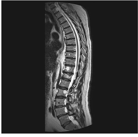 Figure 1 From Case Report An Epidural Cavernous Hemangioma Mimicking A