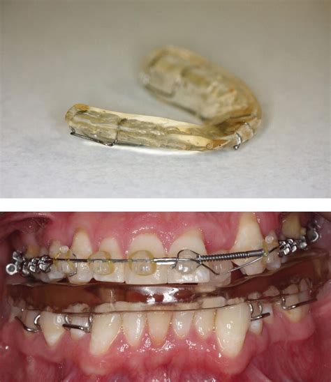 Treatment For Class Ii Malocclusion Pocket Dentistry