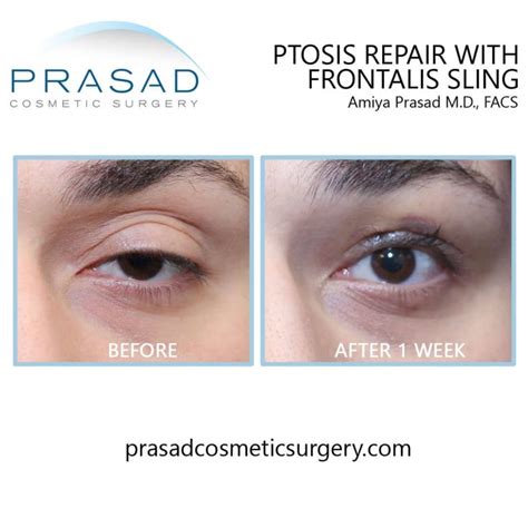 Healing After Ptosis Surgery Dr Prasad Blog