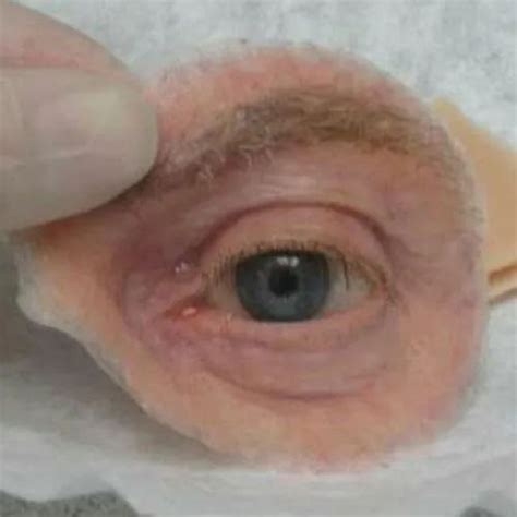 Silicone Cosmetic Eye Prosthesis Size Oricular At ₹ 30000 In Nagpur