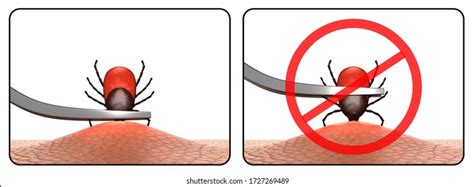 Tick Removal Images, Stock Photos & Vectors | Shutterstock