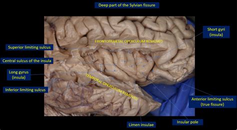 Neuroanatomy Sylvian Fissure Statpearls Ncbi Bookshelf