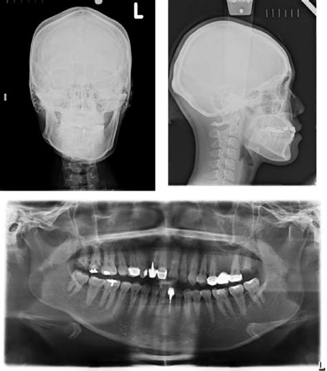 Pretreatment PA Lateral Cephalometric And Panoramic Radiographs