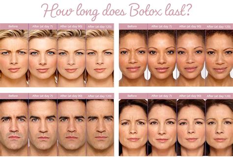 Learn How Long Botox Lasts When To Touch Up Babyface Medspa Az