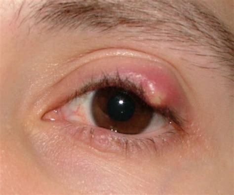 How To Get Rid Of A Chalazion Fast Cyst Boil Abscess